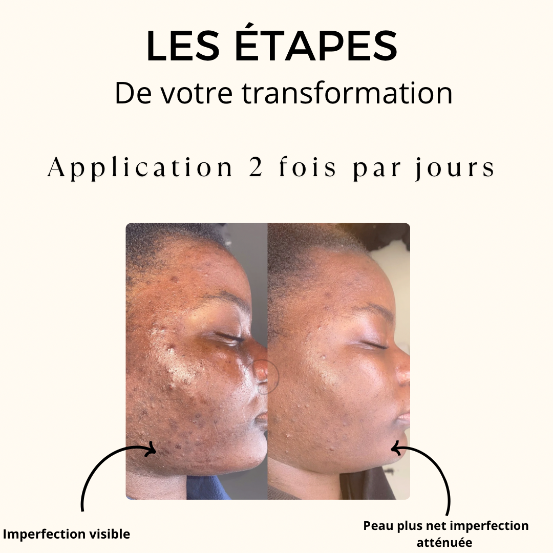 Crème Anti-acné